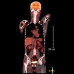 PET-CT scan showing FDG uptake patterns used in oncology imaging for 18F-FDG reporters training.