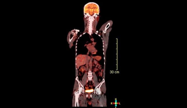 PET-CT scan showing FDG uptake patterns used in oncology imaging for 18F-FDG reporters training.