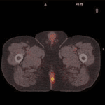 anal cancer pet-ct scan