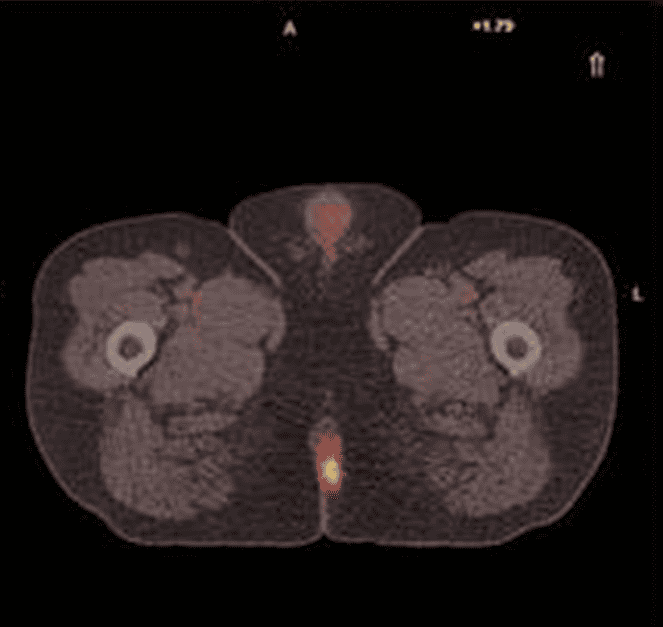 anal cancer pet-ct scan