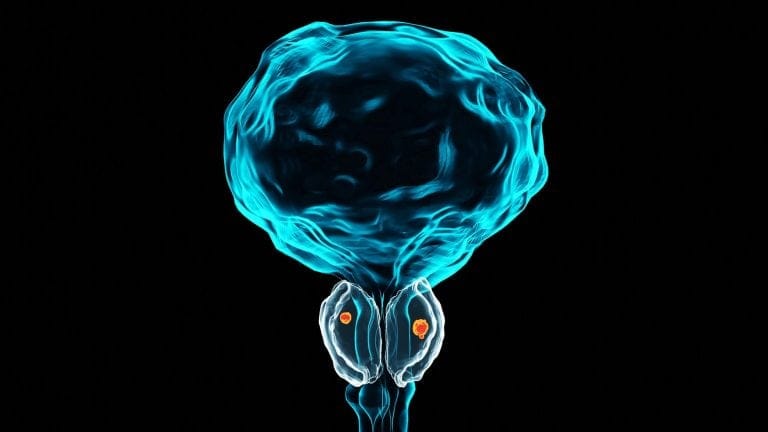 Choline PET-CT scan of the pelvic region showing tracer uptake patterns used for detecting and assessing prostate malignancy.