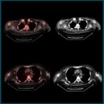 pet-ct scan showing artefacts