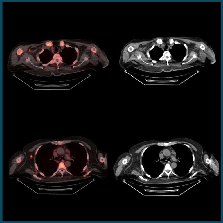 pet-ct scan showing artefacts