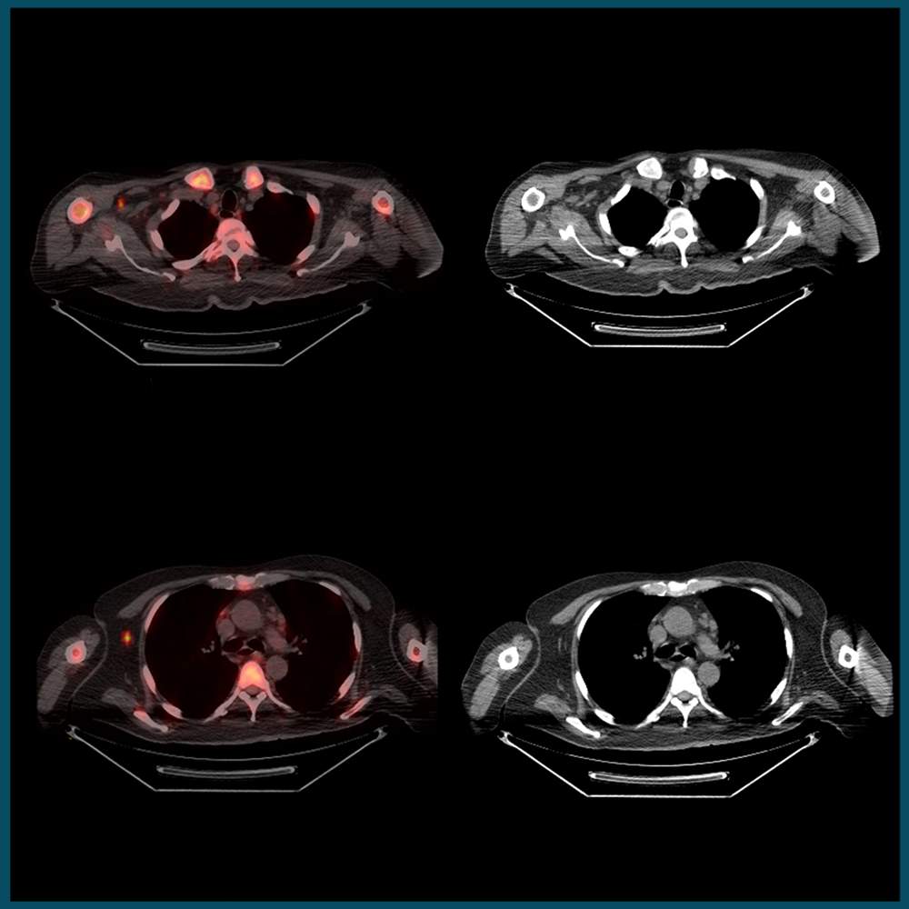 pet-ct scan showing artefacts