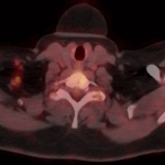 breast cancer pet-ct scan image