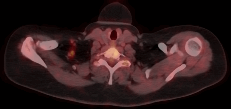 breast cancer pet-ct scan image