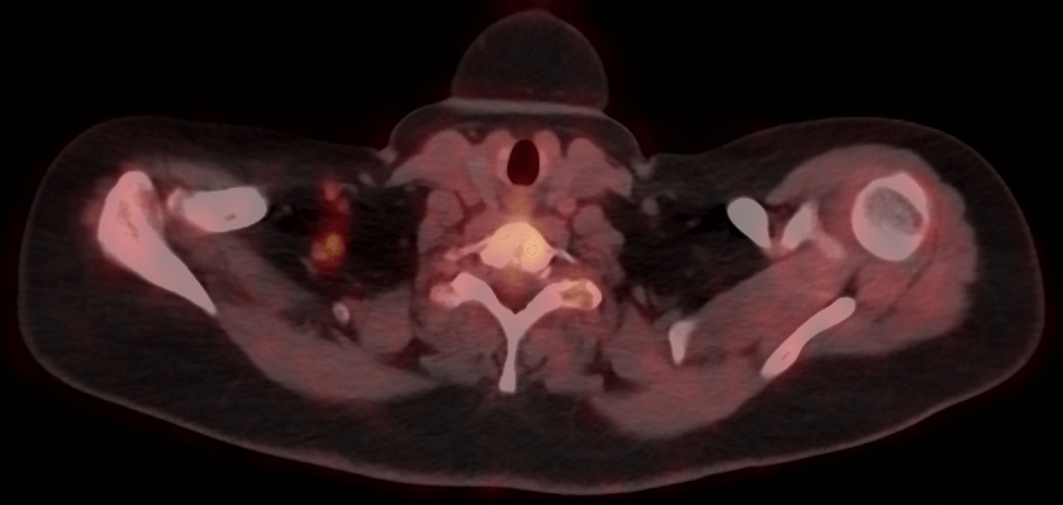 breast cancer pet-ct scan image