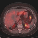colorectal pet-ct scan image