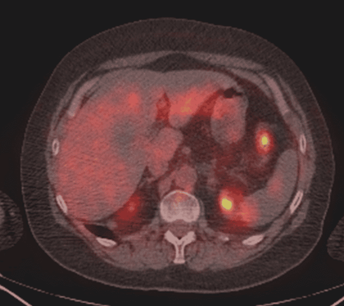 colorectal pet-ct scan image