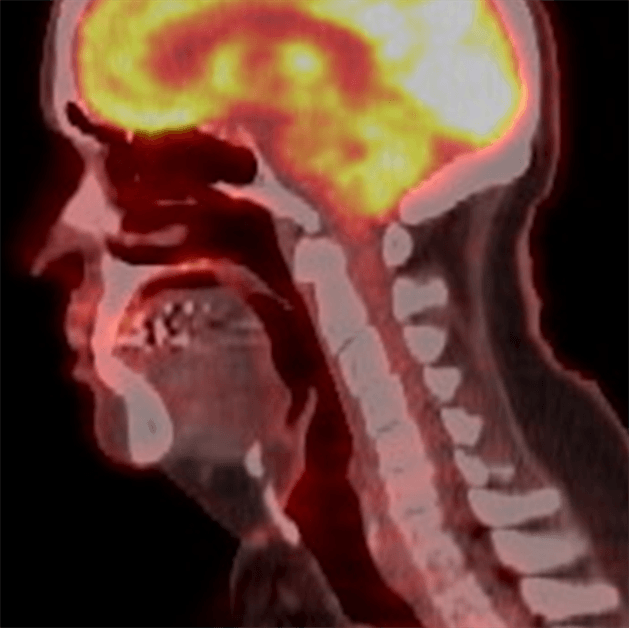 head and neck pet-ct scan image
