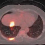 lung pet-ct scan image