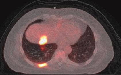 lung pet-ct scan image