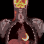 lymphoma pet-ct scan image