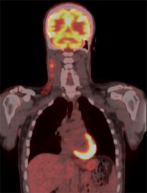 lymphoma pet-ct scan image