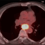 oesophageal pet-ct scan image