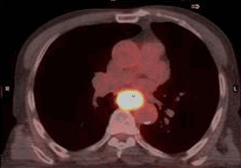 PET-CT scan showing cross-sectional view of the thoracic region with highlighted metabolic activity in the oesophagus for diagnostic reporting